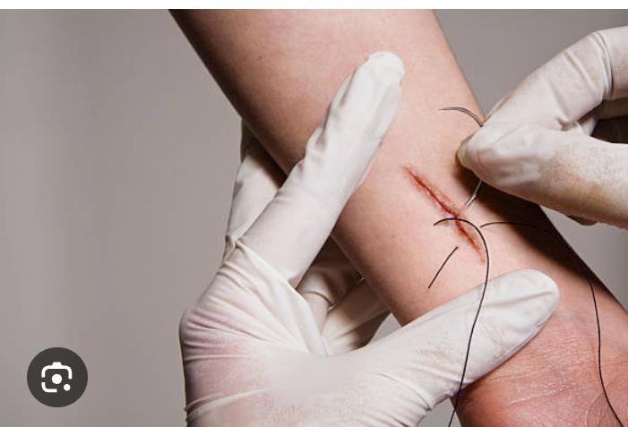 Stitch Removal slide 2