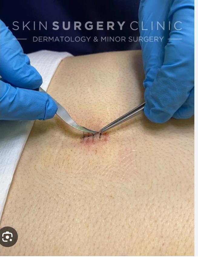 Stitch Removal slide 3